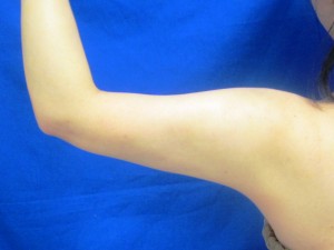 術後3ヶ月　左後面